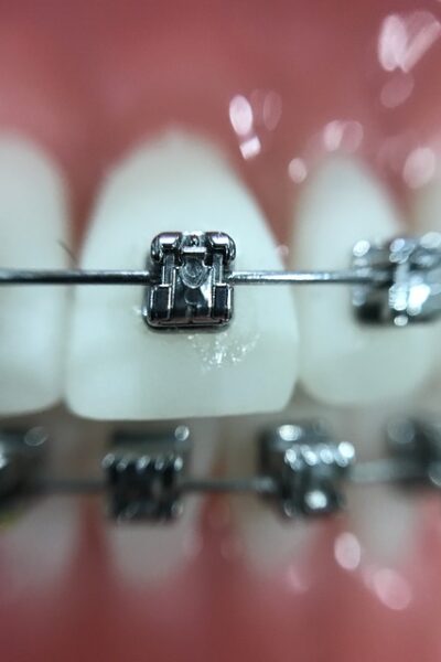 Aumento osseo e ortodonzia