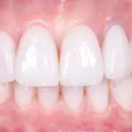 Benefici delle corone in ceramica