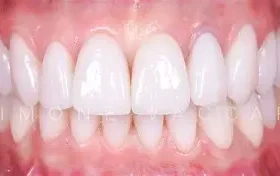 Benefici delle corone in ceramica