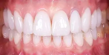 Benefici delle corone in ceramica