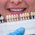 La scelta del colore delle faccette dentali