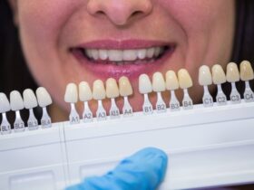 La scelta del colore delle faccette dentali