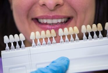 La scelta del colore delle faccette dentali