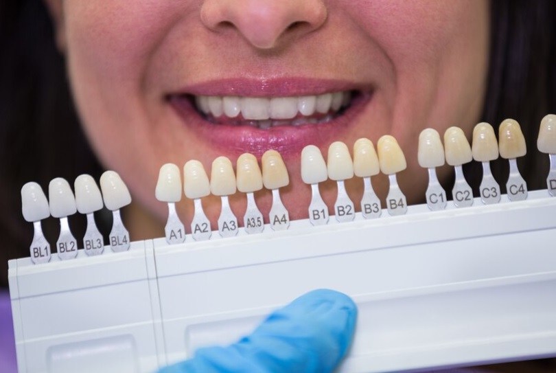 La scelta del colore delle faccette dentali