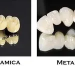 Corone Dentali per Sportivi: Protezione e Prestazione