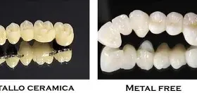 Corone Dentali per Sportivi: Protezione e Prestazione