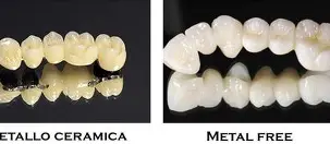 Corone Dentali per Sportivi: Protezione e Prestazione