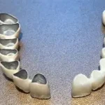 Materiali per corone dentali