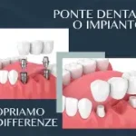Ponte su denti naturali