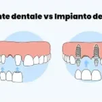 Differenze tra ponti e impianti: Una guida completa