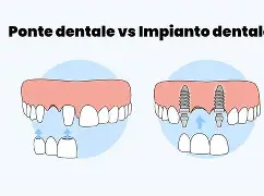 Differenze tra ponti e impianti: Una guida completa