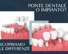 Differenze tra ponti e impianti