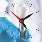 Durata degli impianti dentali