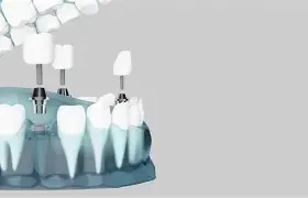 Innovazioni in implantologia