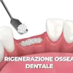 Rigenerazione ossea