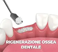 Rigenerazione ossea