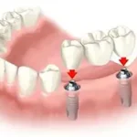 Ponti su Impianti per la Riabilitazione Multipla