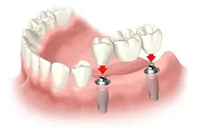Ponti su Impianti per la Riabilitazione Multipla