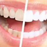 Sbiancamento dentale per denti adiacenti agli impianti