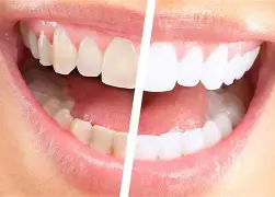 Sbiancamento dentale per denti adiacenti agli impianti