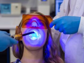 Faccette per Eliminare i Gap tra i Denti