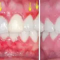 Prevenzione delle malattie dentali