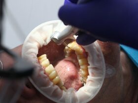 Effetti dello sbiancamento sui denti cariati