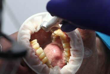 Effetti dello sbiancamento sui denti cariati