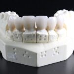 Correzione di malocclusioni con protesi su impianti