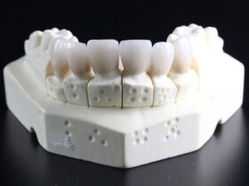 Correzione di malocclusioni con protesi su impianti