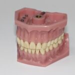 Soluzioni per otturazioni dentali su denti posteriori