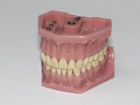 Soluzioni per otturazioni dentali su denti posteriori