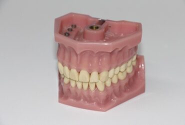 Soluzioni per otturazioni dentali su denti posteriori