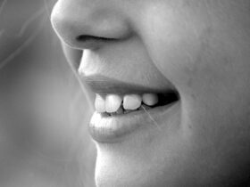 Rinnovamento del sorriso con faccette