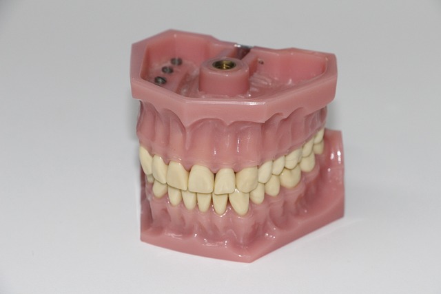 Faccette dentali per denti macchiati