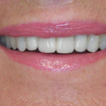 Migliorare il sorriso con l'estetica