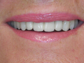 Migliorare il sorriso con l'estetica