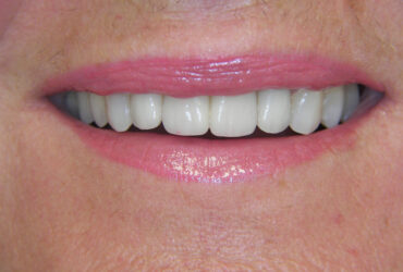 Migliorare il sorriso con l'estetica